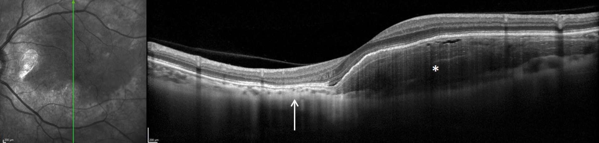 Figure 2. OCT en mode EDI. Changement abrupt entre la zone décalcifiée de l’ostéome choroïdien (flèche blanche) et l’organisation homogène lamellaire de la choroïde dans la zone calcifiée (étoile).
