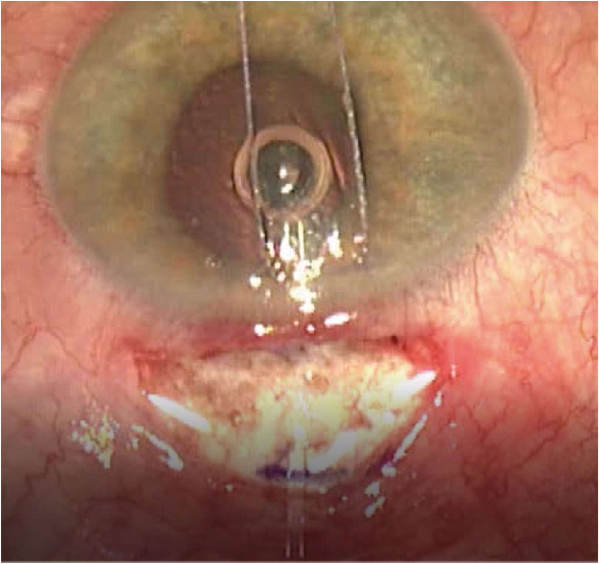 Figure 7. Insertion du drain Micro-Shunt en chambre antérieure, vue peropératoire (drain posé par voie externe).
