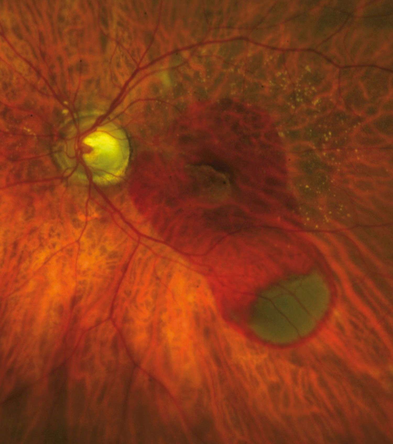 Figure 2c. Évolution à 1 mois postvitrectomie avec injection sous-rétinienne de rt-PA et IVT de gaz et d'anti-VEGF. On visualise bien le déplacement en inférieur de la macula de la composante sous-rétinienne du saignement.
