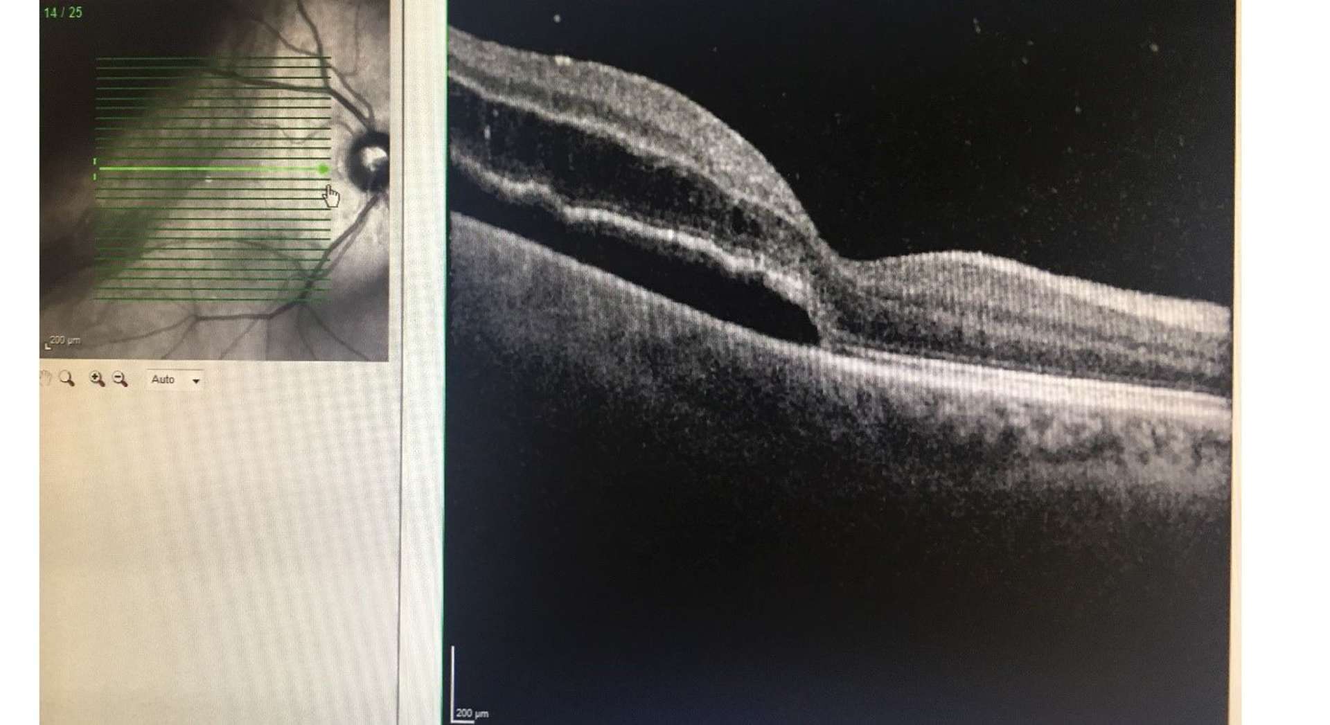 Figure 2. OCT maculaire : macula bissectrisée.
