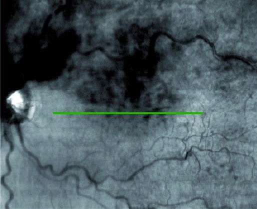 Figure 1. OCT maculaire montrant l’œdème cystoïde diffus et le décollement séreux sous-rétinien central.
