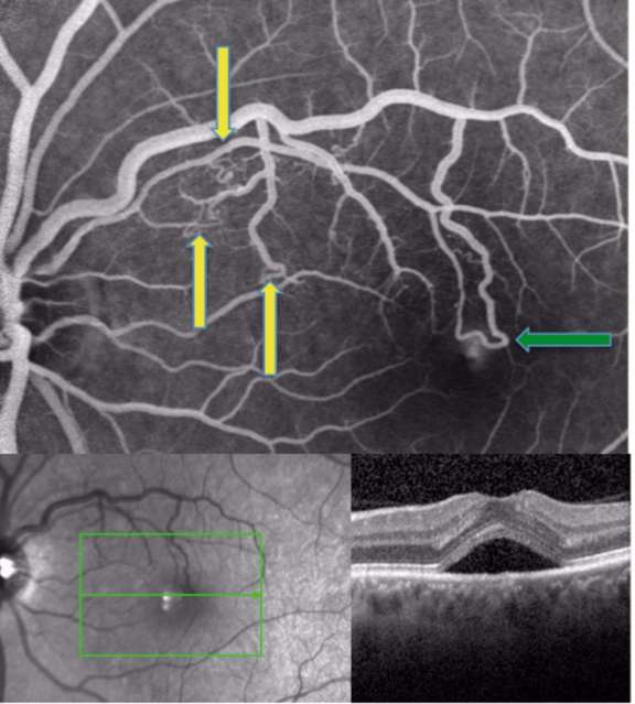 Figure 3. Angiographie à la fluorescéine et OCT maculaire du second cas.
