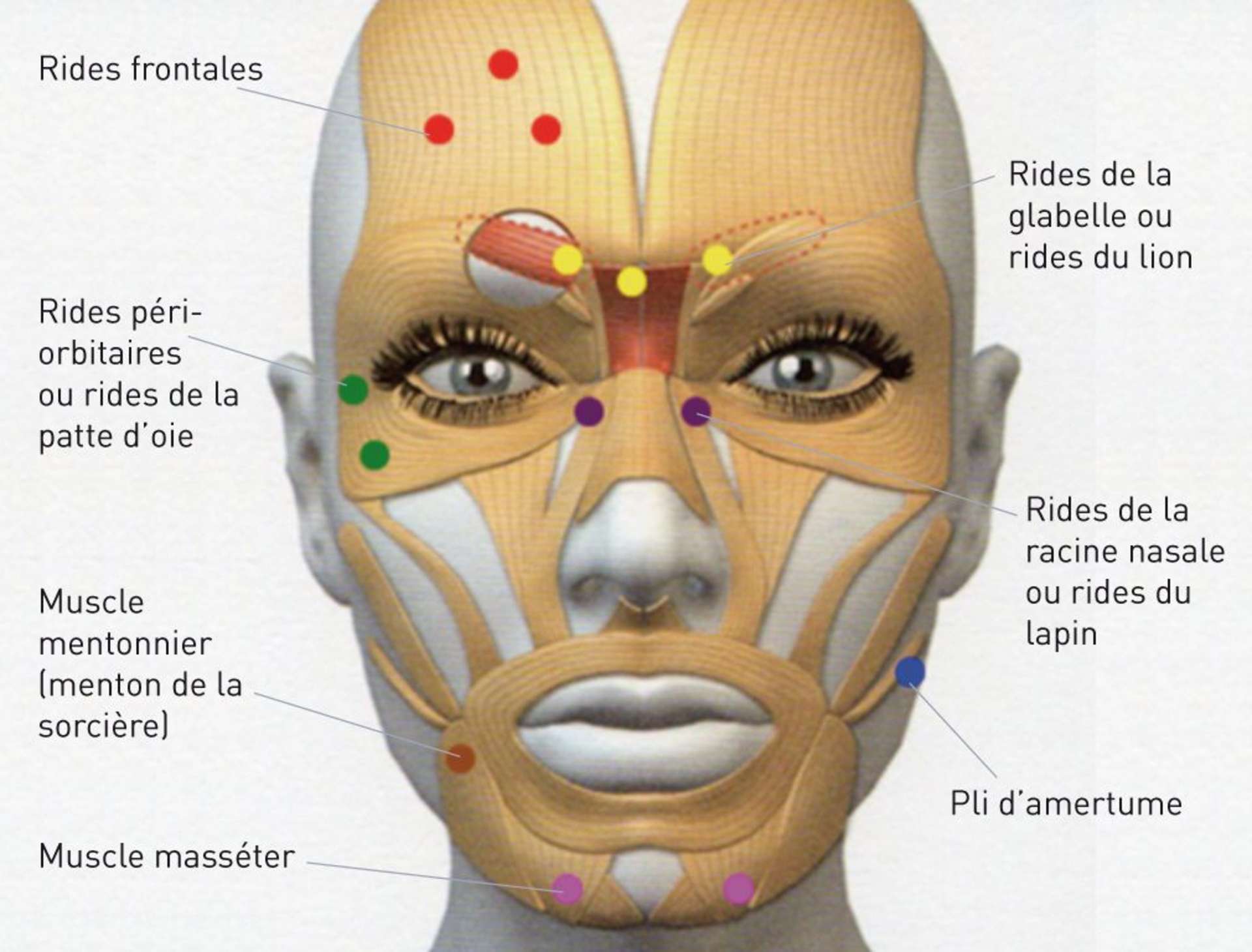 Points d'injection de la toxine
