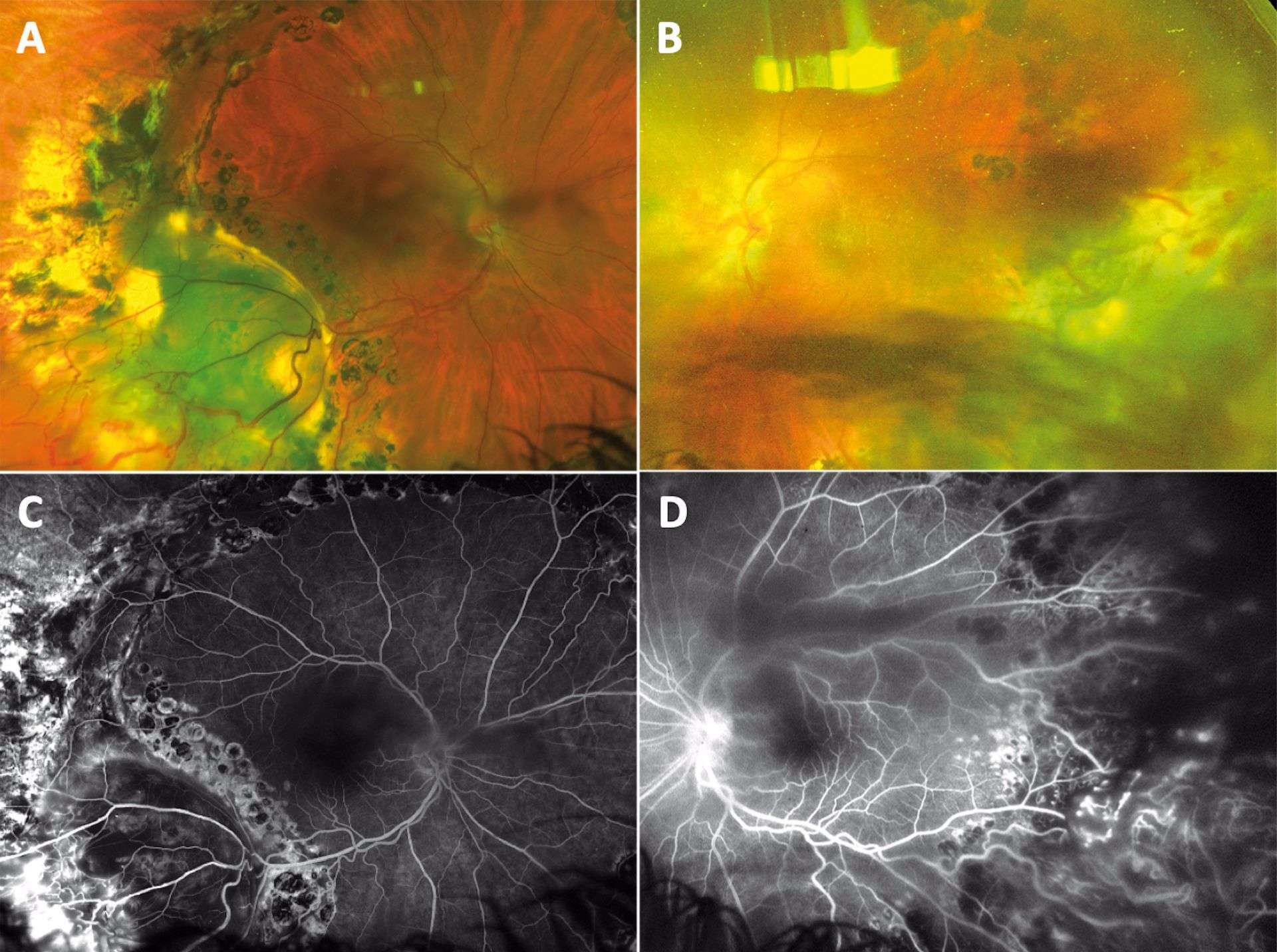 Figure 1. Clichés couleurs ultra grand champ (A et B) et angiographie ultra grand champ (C et D) avant traitement. On retrouve à droite des télangiectasies temporales inférieures (A), assez antérieures, en avant de l’indentation, sur une large zone schisique. Au fond d’œil, à gauche, il existe également une tumeur rétinienne vasoproliférative saillante dans la cavité vitréenne, surmontée de nombreux vaisseaux télangiectasiques (B). L’angiographie à la fluroescéine confirme la présence des télangiectasies de façon bilatérale (C et D).
