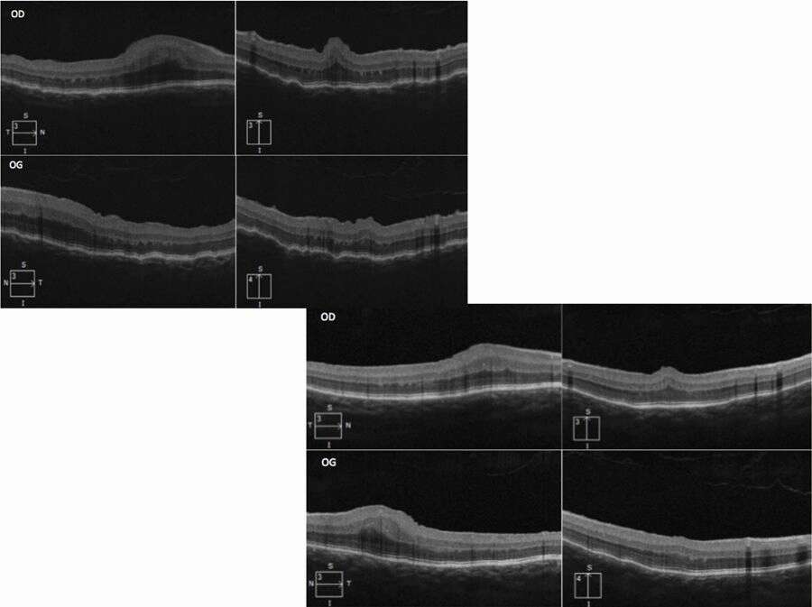 Figure 4. Coupes horizontales et verticales en HD-OCT des 2 yeux (Cirrus, Zeiss). À l’examen initial : plis choroïdiens maculaires visibles. En postopératoire : amélioration du profil maculaire.
