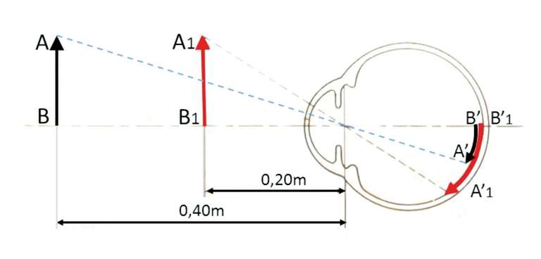 Figure 1. B’A’ est l’image de l’objet AB vu à 0,40 m ; et B’1A’1 est l’image du même objet A1B1 vu à 0,20 m ; à 0,20 m le grandissement de l’image rétinienne est égal à 0,40/0,20 = 2X.
