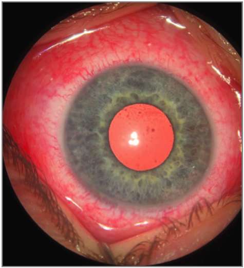 Severe Ocular Lesions and Delayed Re-epithelialization Following Alcohol-Based Hand Sanitizer (ABHS) Eye Exposure
