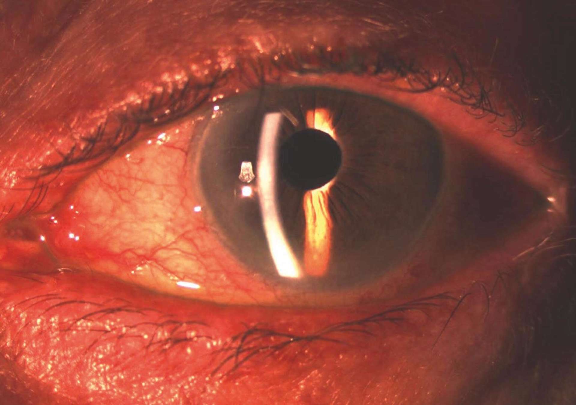 Inflammation de la surface oculaire chez une patiente glaucomateuse sous trithérapie hypotonisante
