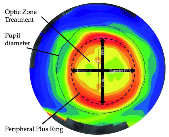 Figure 1. Une carte topographique tangentielle montre le diamètre de l’anneau de puissance positif (APP) analysé en cette étude
