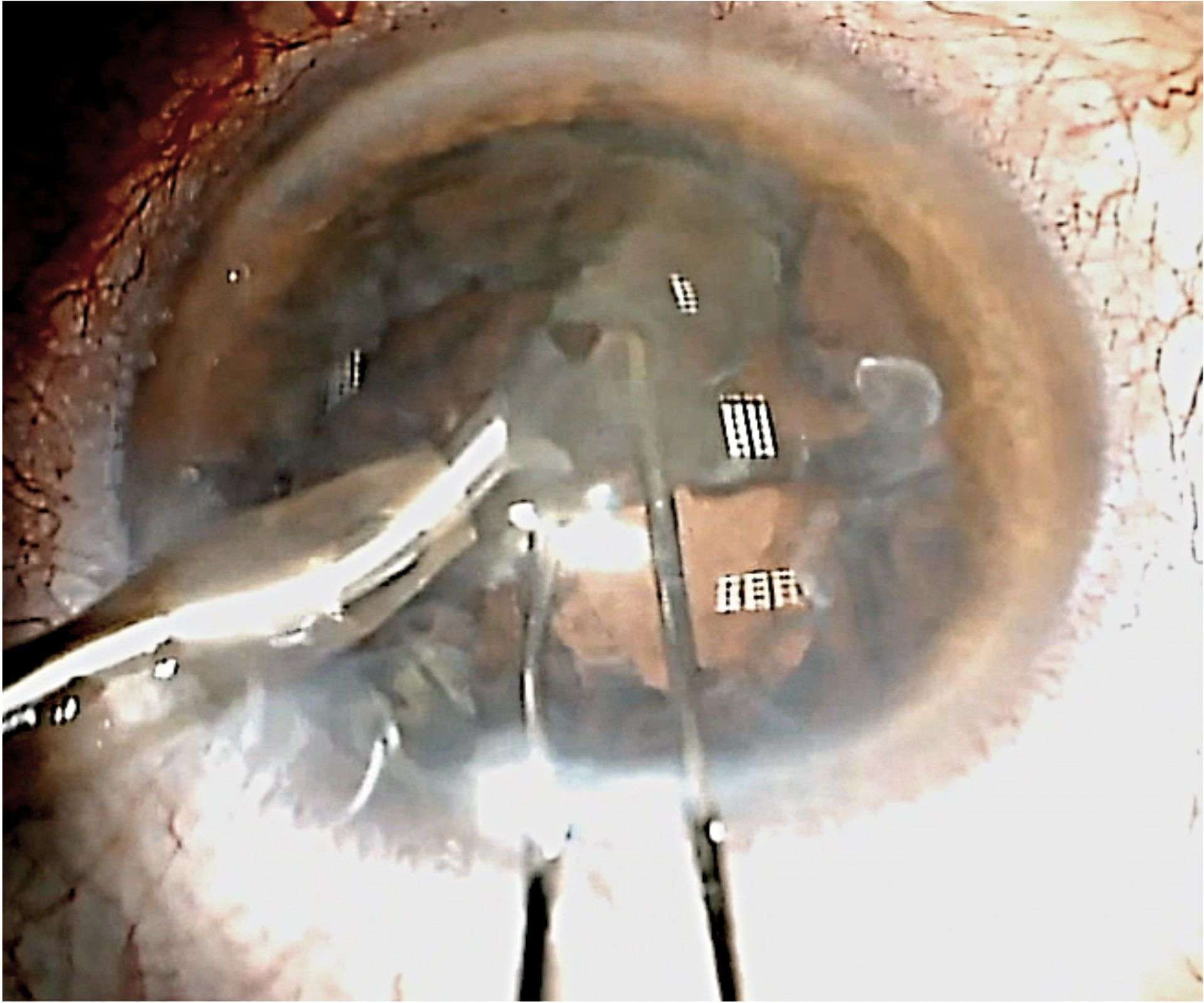 Figure 5. Aiguille 30G (à droite) sous le noyau - rupture capsulaire étendue.
