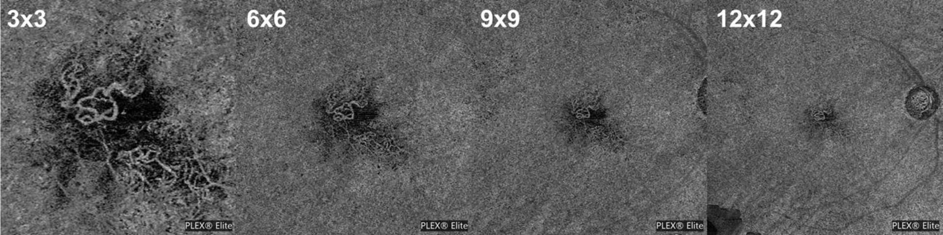 Figure 1. Néovascularisation choroïdienne visualisée sur des clichés d’OCT-A explorant des champs différents : 3 x 3 mm, 6 x 6 mm, 9 x 9 mm et 12 x 12 mm. La visualisation du néovaisseau est de moins en moins aisée avec l’augmentation de la taille du champ d’exploration.
