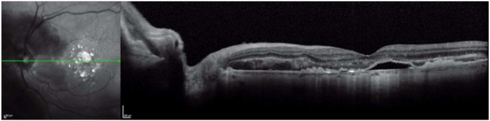 Figure 3. Déplacement inférieur de l’hématome. Persistance d’un DEP sur l’OCT maculaire.
