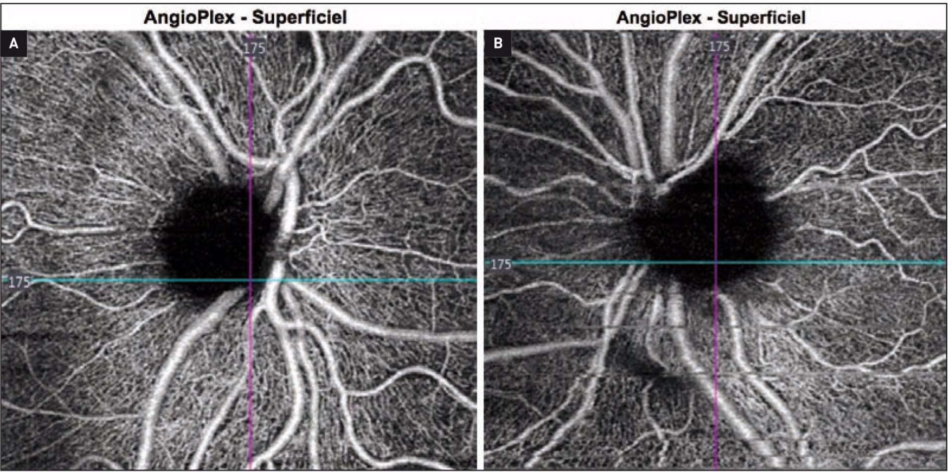 Figure 2. Image d’OCT-A péripapillaire d’un patient non atteint de glaucome (A), d’âge et de sexe similaires que le patient atteint d’un glaucome primitif à angle ouvert (B). On observe une vascularisation homogène et dense sur la circonférence du nerf optique du premier, ainsi qu’une vascularisation globalement moins dense avec une raréfaction localisée dans le secteur temporal supérieur notamment qui est bien corrélée à l’atteinte du champ visuel de la figure 1.
