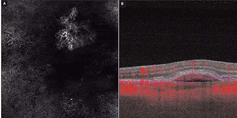Figure 3. OCT-Angiographie avec image en face de flux (A) et B-scan avec superposition de flux (B).
