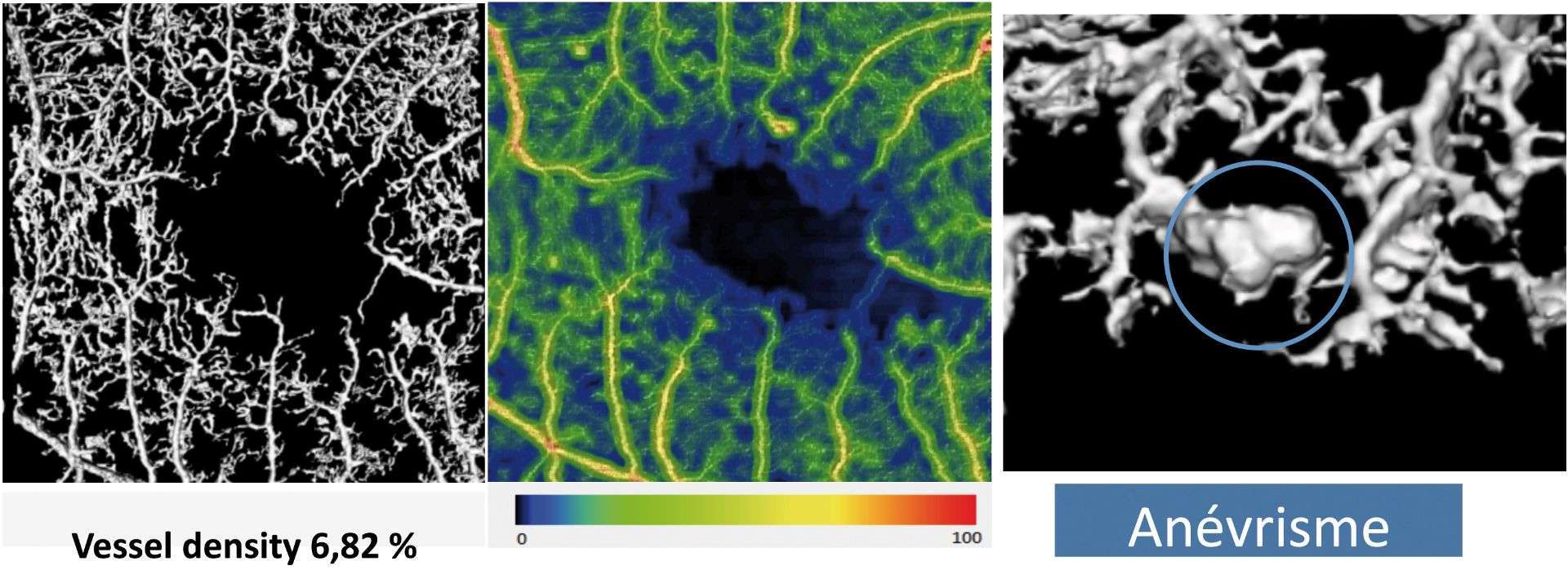 Figure 4. Extraction du réseau vasculaire en 3D à partir de l’acquisition en OCT-A Heidelberg. Par V. Vasseur.
