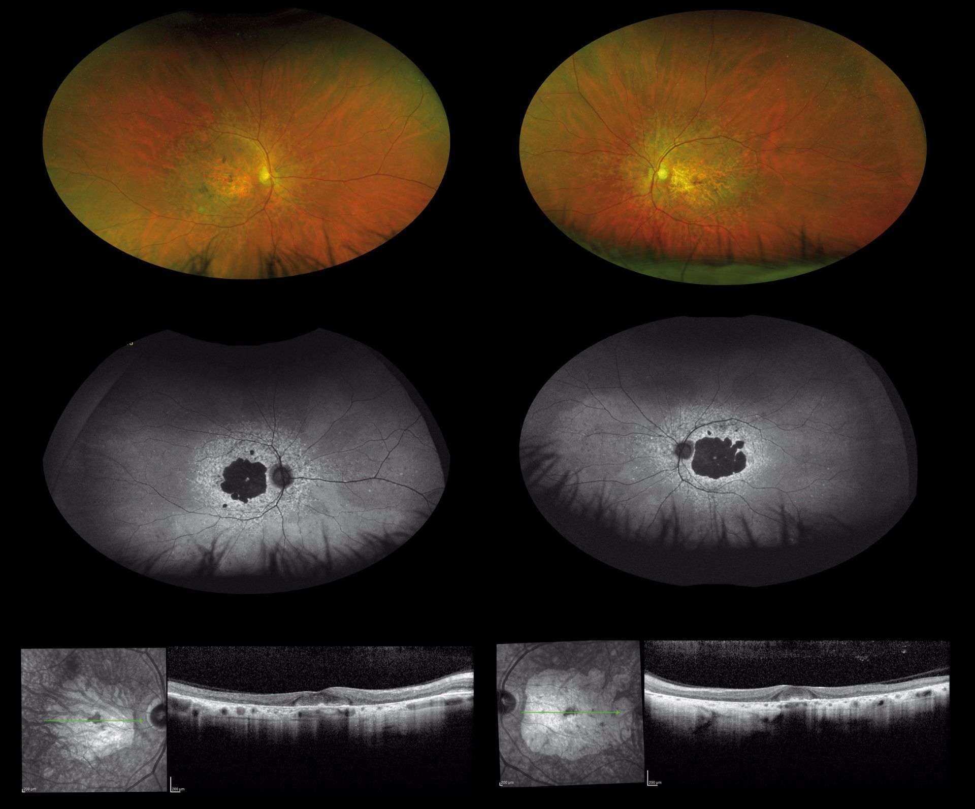 Figure 1. Imagerie multimodale d’un cas de maladie de Stargardt chez une patiente âgée de 58 ans.  À la rétinophotographie « ultra grand champ » (première ligne) l’aire atrophique est perçue comme une lésion blanchâtre arrondie, associée à une visibilité accrue des gros vaisseaux choroïdiens au pôle postérieur. La moyenne périphérie est sans altérations. Sur le bord de l’atrophie, on observe la présence de pigment maculaire. En autofluorescence (deuxième ligne), la zone d’atrophie est hypo-autofluorescente, entourée par un halo hyper-autofluorescent. L’OCT (troisième ligne) montre un amincissement de l’ensemble des couches dans la zone atrophique, associé avec un épargne fovéolaire.
