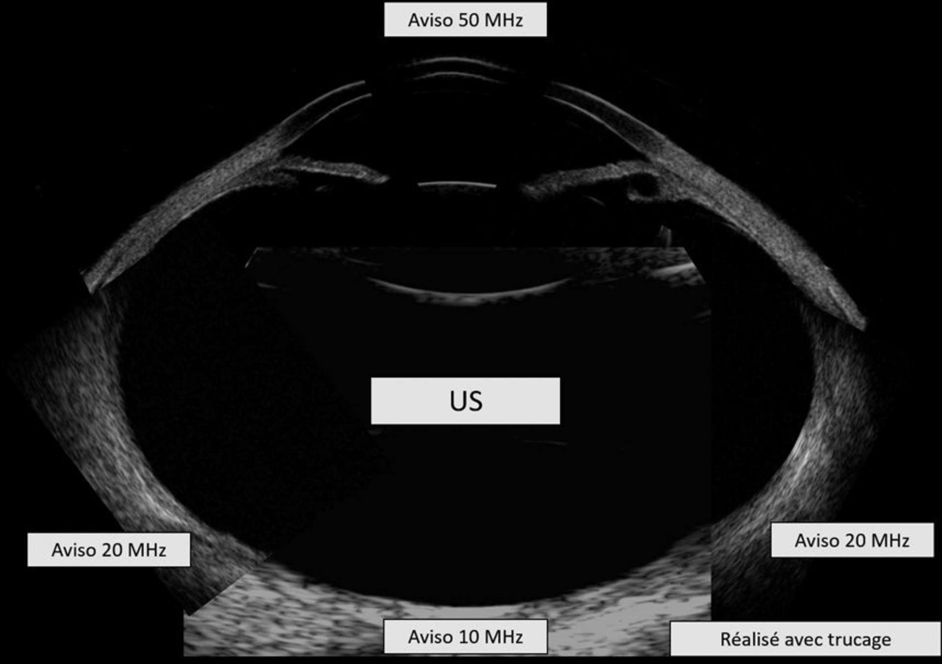 Figure 1. Coupe échographique (réalisée avec trucage) permettant une visualisation complète du globe oculaire.

