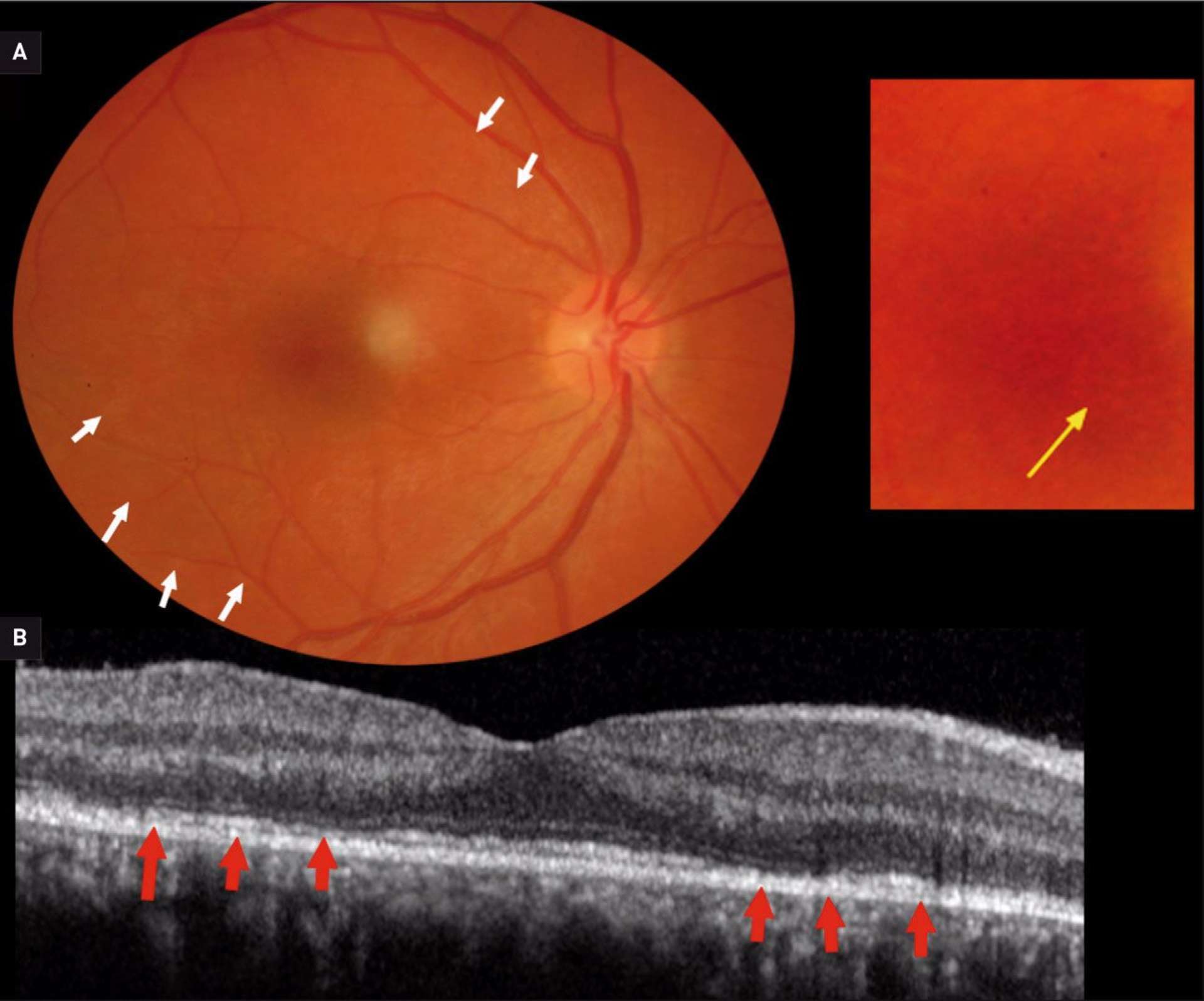 A.Fond d’œil droit : taches blanches visibles au pôle postérieur (flèches blanches) avec l’aspect granité de la macula (flèche jaune). B. OCT-Spectral domain : amincissement de la bande ellipsoïde.
