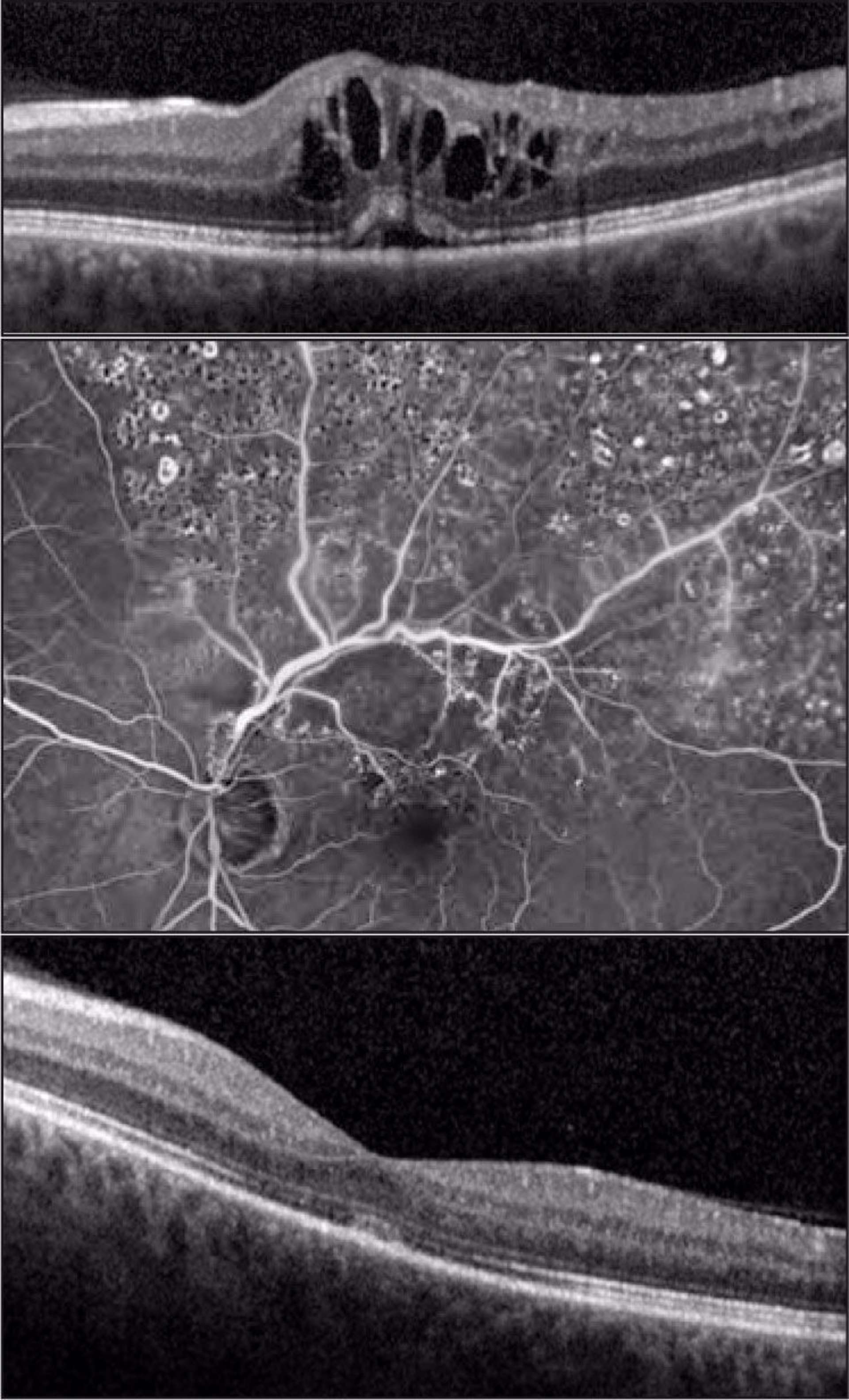 Figure 2. Occlusion de branche veineuse ischémique chez un homme de 57 ans traité par grid maculaire. Devant un OMV récidivant après 2 injections de l’implant de DXM, le traitement en grid maculaire (impacts espacés à l’intérieur des arcades dans la zone œdémateuse) associé à une PPR sectorielle dans la zone ischémique a permis de guérir définitivement l’OMV.
