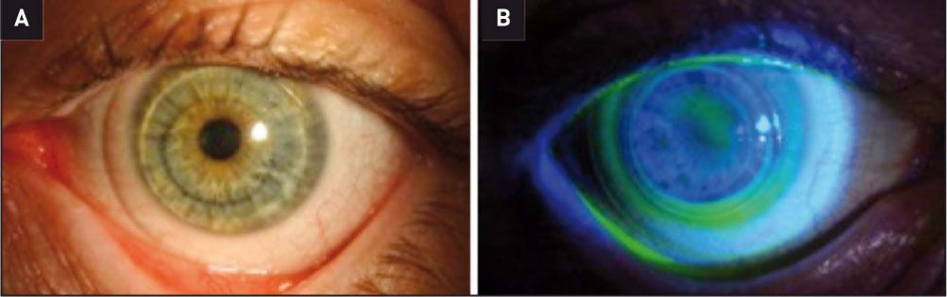 Figure 5. Exemple d’adaptation en lentille hybride. A. Image en lumière blanche. La mobilité de cette lentille est équivalente à celle d’une lentille souple, soit 0,50 mm. B. Image en lumière bleue après l’instillation de fluorescéine macromolécule. Il faut vérifier  l’absence d’appui central au niveau du kératocône et une répartition homogène de la fluorescéine au niveau de la zone de jonction.
