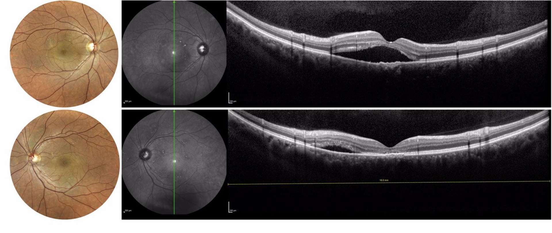 Figure 3. Patient présentant une crise de CRSC bilatérale avec atteinte maculaire droite et inféro-maculaire gauche. La réalisation de coupes larges permet de ne pas méconnaître plus facilement une atteinte extramaculaire ou multifocale. Les coupes présentées dans cet exemple mesurent 17 mm de largeur (images réalisées avec le Spectralis HRA-OCT2 d’Heidelberg et RPC Eidon de Centervue).
