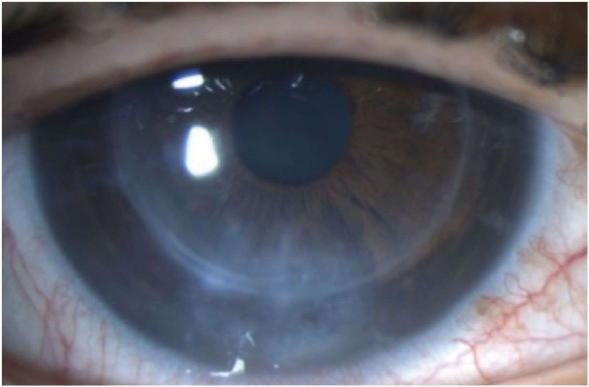 Figure 1A. Photographie de l’examen initial de l’œil gauche.

