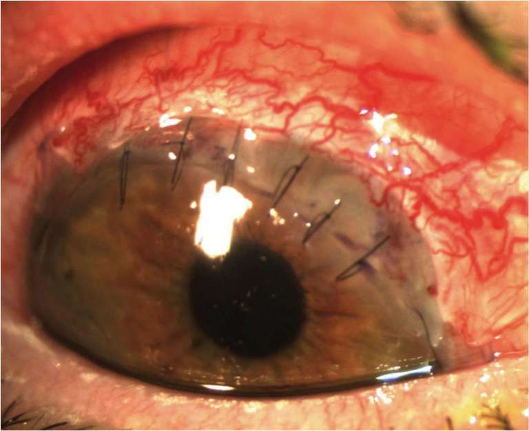 Figure 3. Photographie postopératoire J5 de l’œil droit.
