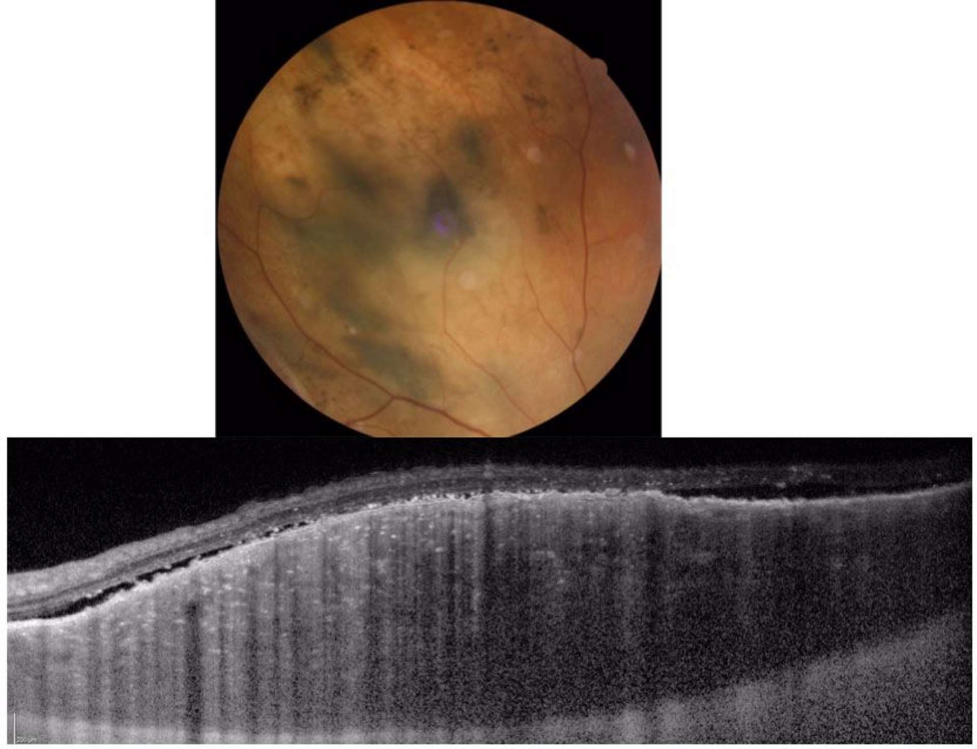 Mélanome choroïdien. Lésion choroïdienne, en dôme accompagnée de décollement séreux rétinien, de photorécepteurs « shaggy » ou épaissis et d’une disparition de la choriocapillaire.
