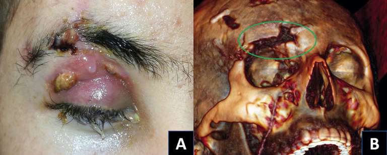 Figure 5. A = fistule palpébrale + sourcilière droite de LCR responsable d’une ­oculorrhée chez un patient victime d’un traumatisme crânien. B = défect osseux du toit de l’orbite avec brèche dure mérienne associée (cercle vert).
