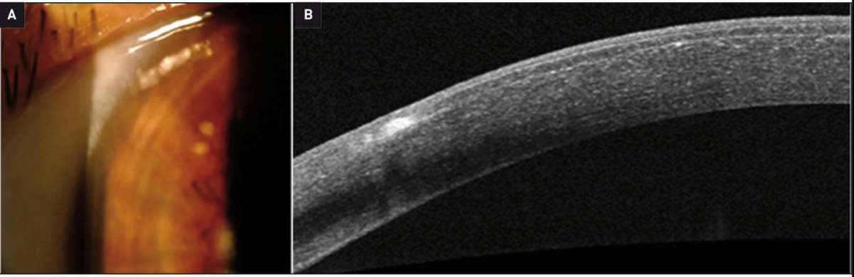 Figure 5. Photo de l’œil gauche (A) montrant l’infiltrat périphérique et OCT correspondant (B) à 1 mois post-Lasik.
