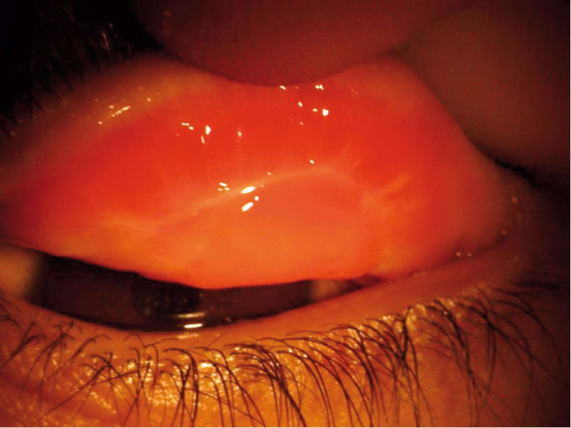 Fibrose sous-épithéliale stade I de la paupière supérieure droite.
