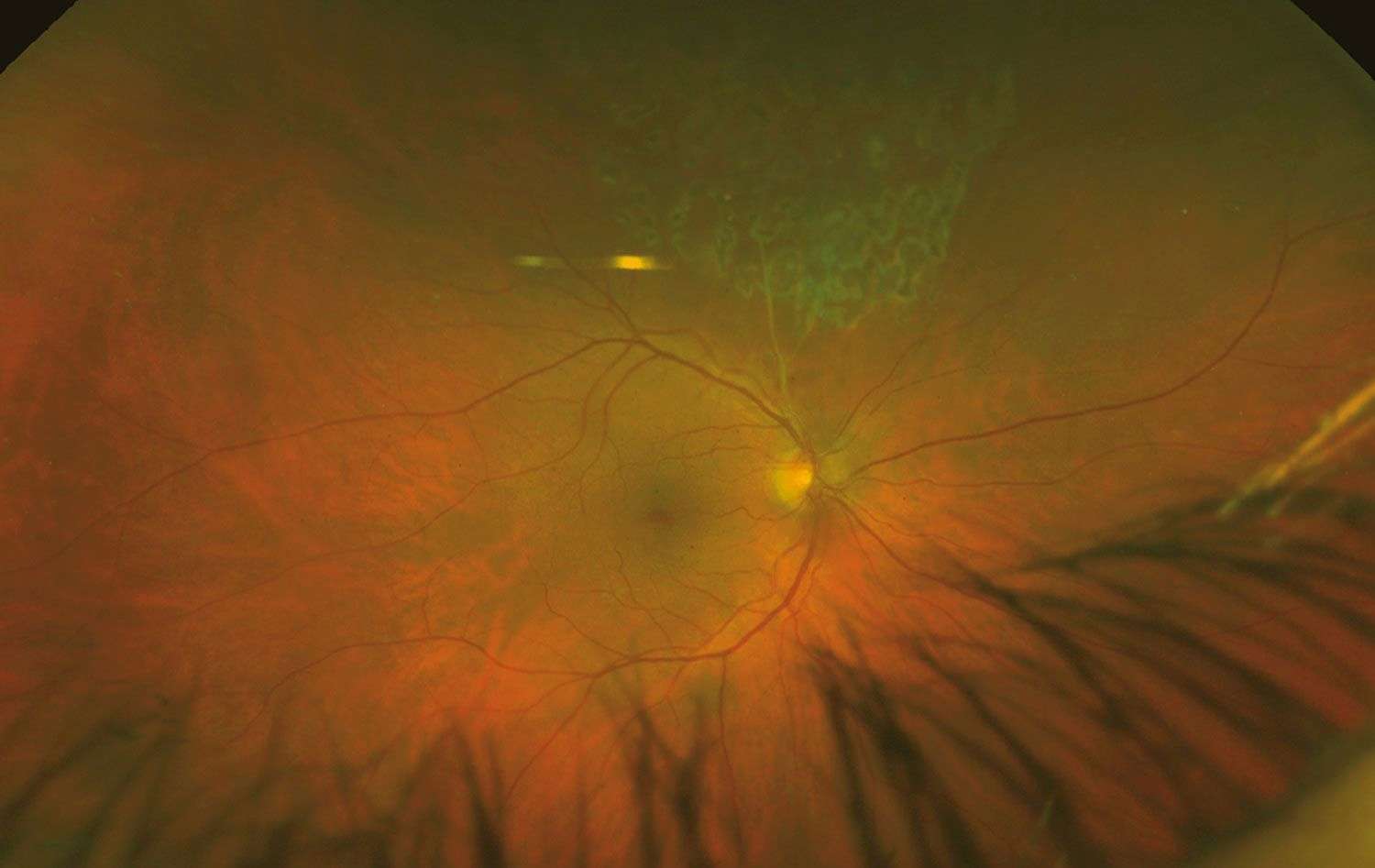 Figure 3. Imagerie rétinienne ultra-grand champ (Optos) de l’œil droit postopératoire d’une vitrectomie pour une occlusion de branche veineuse rétinienne supérieure.
