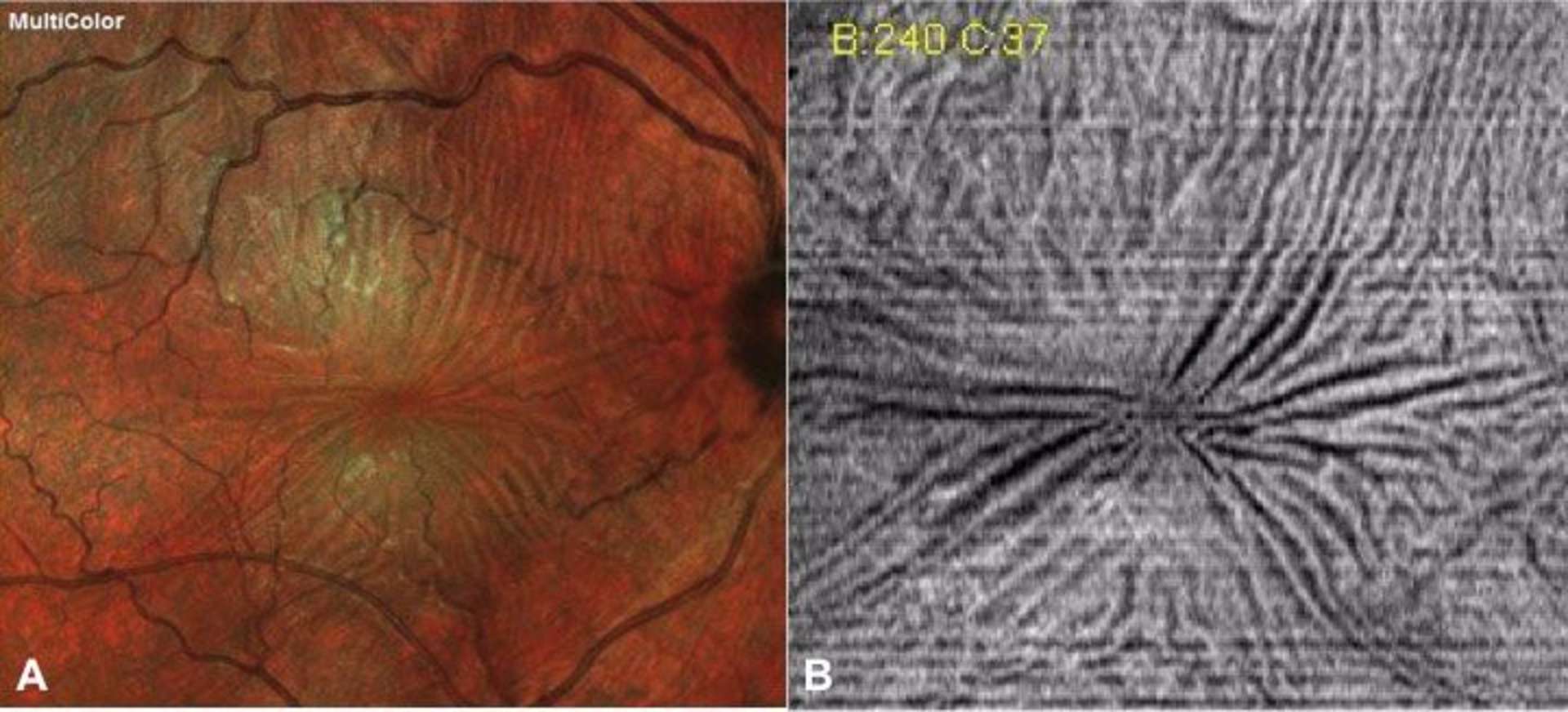 A.Cliché Multicolor de l’œil droit réalisé à l’aide du Spectralis d’Heidelberg montrant la présence de plis rétiniens superficiels et d’une tortuosité des vaisseaux secondaires à l’existence d’une membrane épirétinienne. B.Cliché C-scan dans le plan de la membrane limitante interne montrant ces mêmes plis maculaires.
