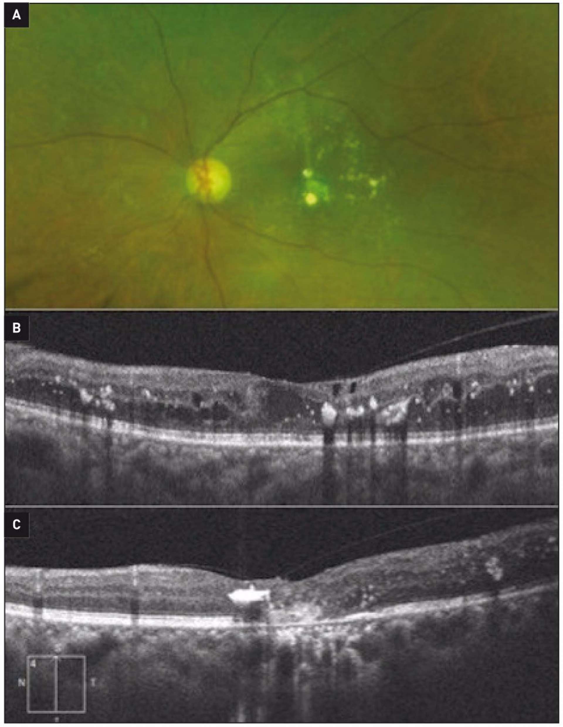 Figure 1. Œdème maculaire diabétique (OMD) avec bonne réponse anatomique sans gain fonctionnel après un traitement par injections intravitréennes.
A. Rétinographie œil gauche retrouvant des exsudats proches du centre. B. OCT maculaire avant traitement : OMD associé à la présence d’exsudats (ayant un aspect hyperréflectif et situés au niveau de la couche plexiforme externe). C. OCT maculaire après traitement. On note un assèchement rétinien et la disparition des logettes d’œdème intrarétinien mais la persistance d’exsudats centraux, ainsi que des altérations des couches externes de la rétine, responsables de l’absence de récupération fonctionnelle.
