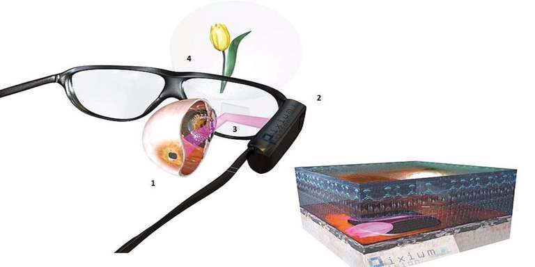 Figure 2. Principe de fonctionnement du système PRIMA : l’implant sous-rétinien (1) est stimulé par émission d’un faisceau laser (2) transmis à travers les lunettes (3) et représentant l’image capturée par la caméra fixée sur les lunettes (4).
