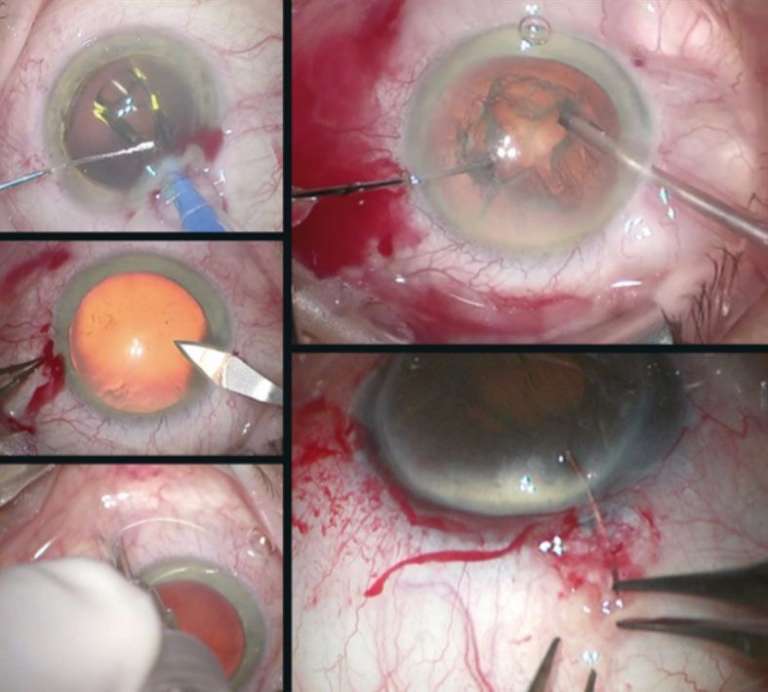 Figure 3. Exemples de gestes pouvant être douloureux sous anesthésie topique : tenue du globe oculaire, injection sous-ténonienne, suture cornéenne limbique, implantation à la berge, rotation du cristallin.
