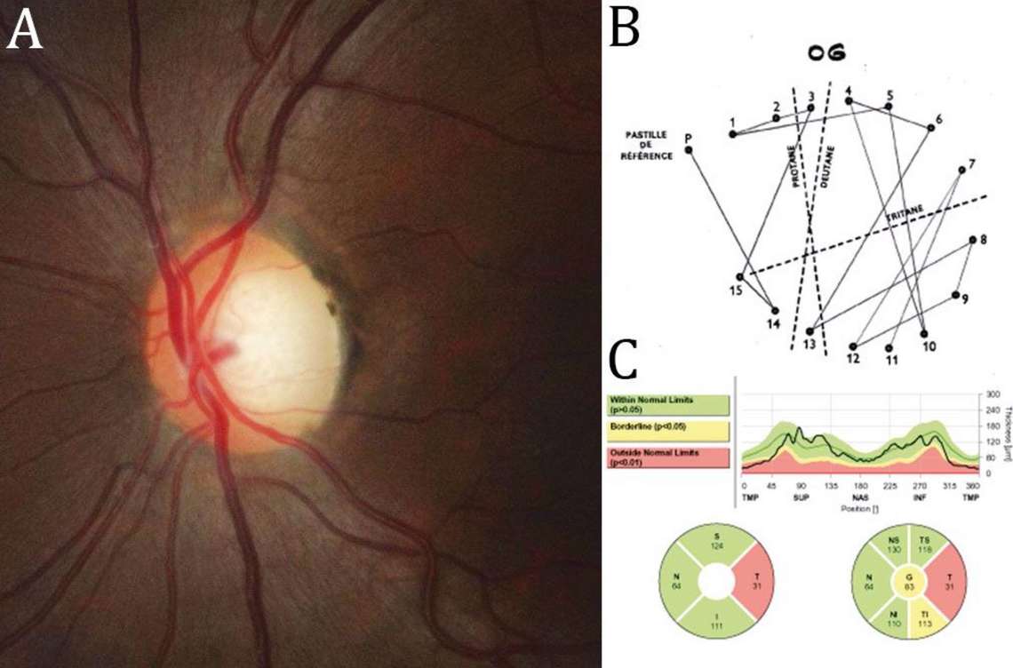 Neuropathie optique non glaucomateuse qui a été initialement confondue avec un glaucome à pression normale.
