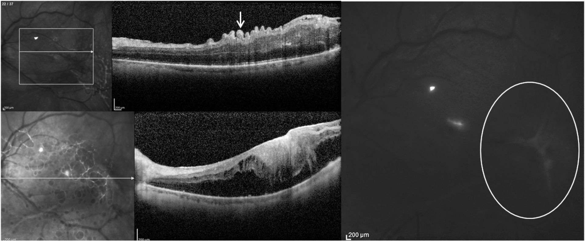 Patient de 72 ans, opéré de décollement de rétine total, présentant, deux mois après la chirurgie, un volumineux pucker extrafovéolaire tractant le pôle postérieur en temporal (cercle blanc). La rétine interne est plissée (flèche blanche). L’acuité visuelle a chuté de 4/10 après la chirurgie à 0,5/10.
