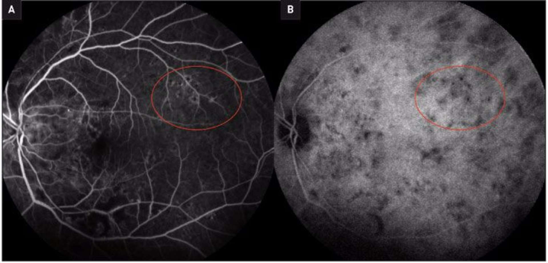 Figure 4. Lésions hypofluorescentes en angiographie à la fluorescéine (A), également hypocyanescentes en ICG (B) correspondant à des taches d’Elschnig sur les clichés au temps tardif.
