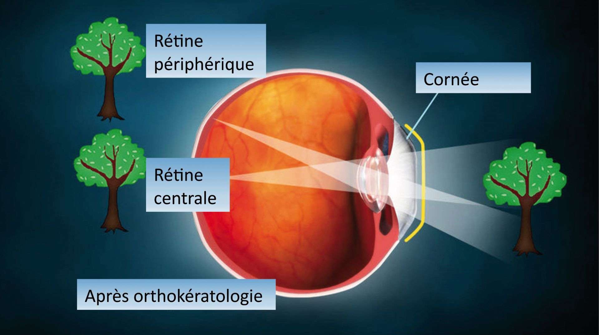 Figure 3. Principe du défocus myopique (« stop signal ») en orthokératologie. Effet freinateur par blocage du défocus hypermétropique (grow signal).
