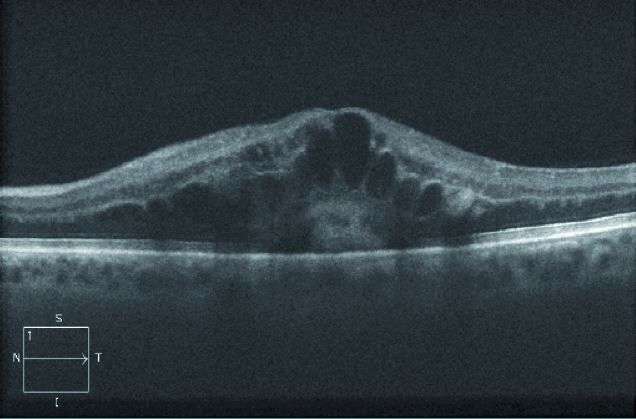 Figure 1. OCT maculaire montrant l’œdème cystoïde diffus et le décollement séreux sous-rétinien central.
