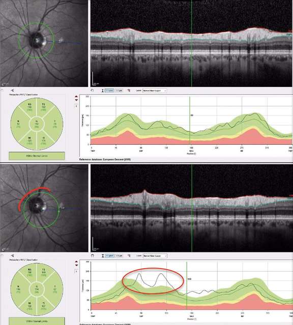 Figure 1. Haut. OCT RNFL normal (de haut en bas et de gauche à droite) : photographie infrarouge de la papille permettant d’apprécier le bon centrage du cercle d’analyse (vert) et repérage de l’axe fovéa-nerf optique (bleu), déroulé de l’OCT B-scan (segmentation), moyennes d’épaisseur par quadrant et moyenne (G), rapport TSNIT : aspect en double bosse correspondant aux paquets vasculo-nerveux temporaux supérieur et inférieur. Bas. Même patient avec mauvais centrage de l’acquisition : en rouge, surestimation de l’épaisseur RNFL à mesure que l’on se rapproche de la papille et inversement (OCT Spectralis, Heidelberg).
