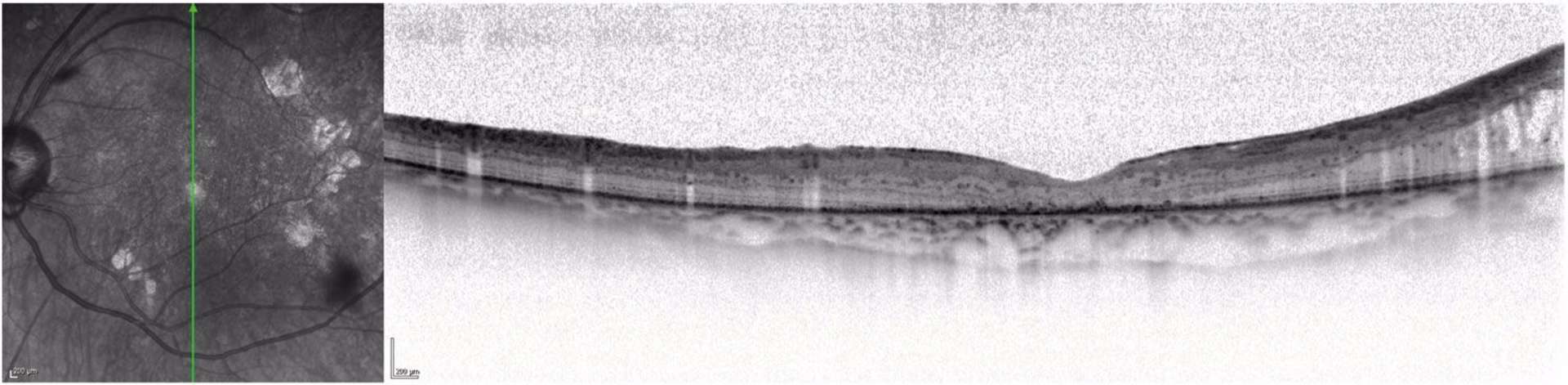 Figure 2. Atrophie des couches externes de la rétine dans la région maculaire après la résolution de l’œdème.
