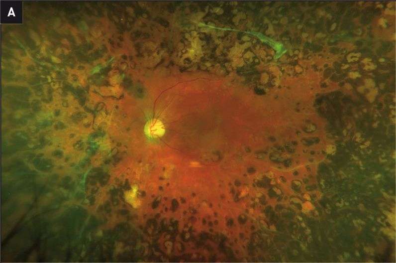 Figure 1. Patiente diabétique de type 1 anciennement traitée pour une rétinopathie diabétique proliférante floride présentant un œdème maculaire central de l’œil gauche. A. Rétinophotographie couleur ultra-grand champ de l’œil gauche montrant les voiles fibrovasculaires inactifs, séquellaires de la rétinopathie proliférante, et une panphotocoagulation rétinienne complète.
