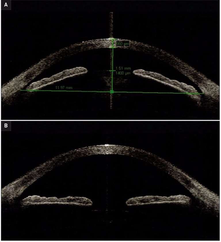 Figure 2. A. UBM préopératoire d’un GCFA. La flèche cristallinienne est importante (1 400 microns), la chambre antérieure est étroite. B. UBM postopératoire d’une chirurgie de la cataracte du même patient. Augmentation de l’ouverture de l’angle et de la profondeur de CA.
