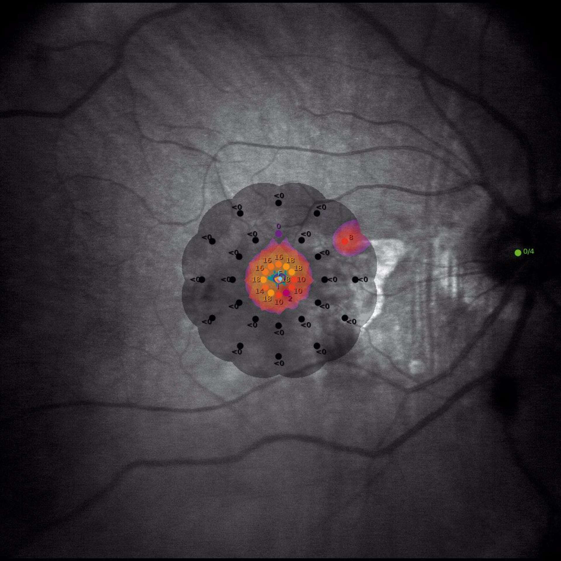 Figure 4. Image de préservation maculaire en micropérimétrie (MAIA).
