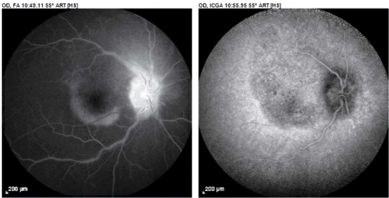 Figure 4. Aux phases plus tardives, la FA montre l’inflammation du nerf optique, ou papillite, et la plaque qui devient hyper­fluorescente ; l’angiographie rétinienne au vert d’indocyanine, ou ICG, montre que la lésion est hypofluorescente au temps plus tardif seulement.
