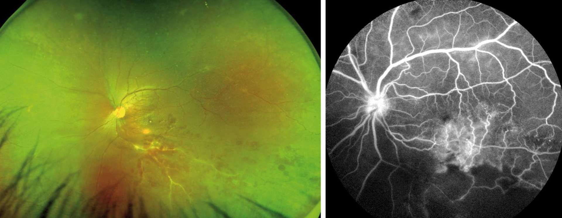 Figure 5. Photo (caméra ultra grand champ) et angiographie à la fluorescéine montrant une vascularite veineuse avec occlusion de branche veineuse (temporal inférieure) et périphlébites disséminées.
