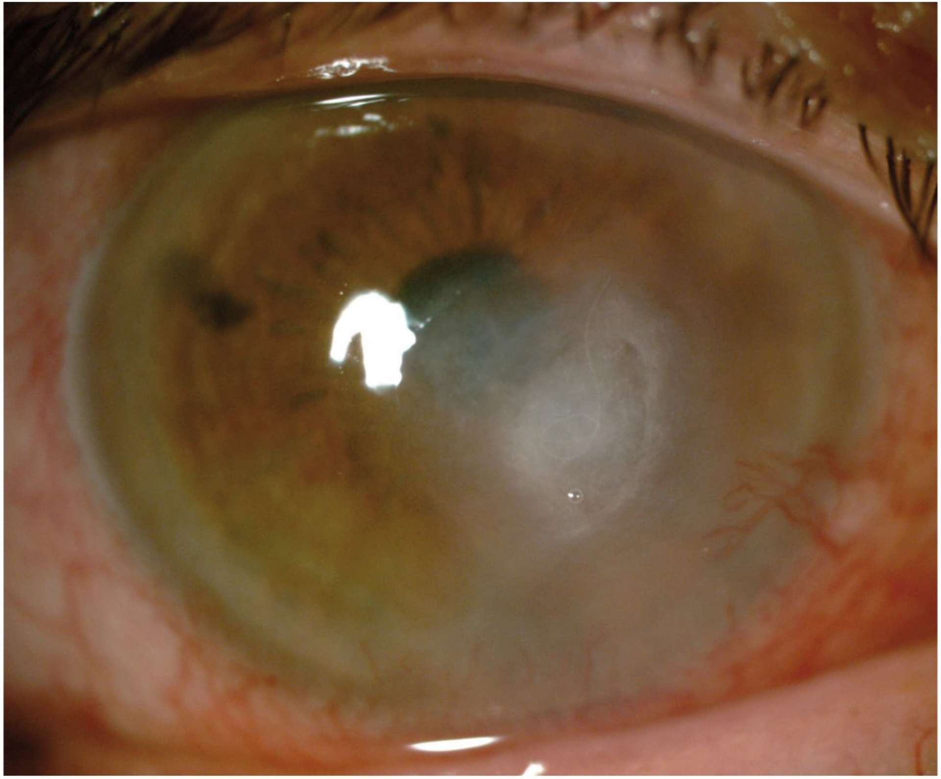 Figure 2B. Surinfection à Moraxella lacunata d’une kératite herpétique stromale récidivante.
