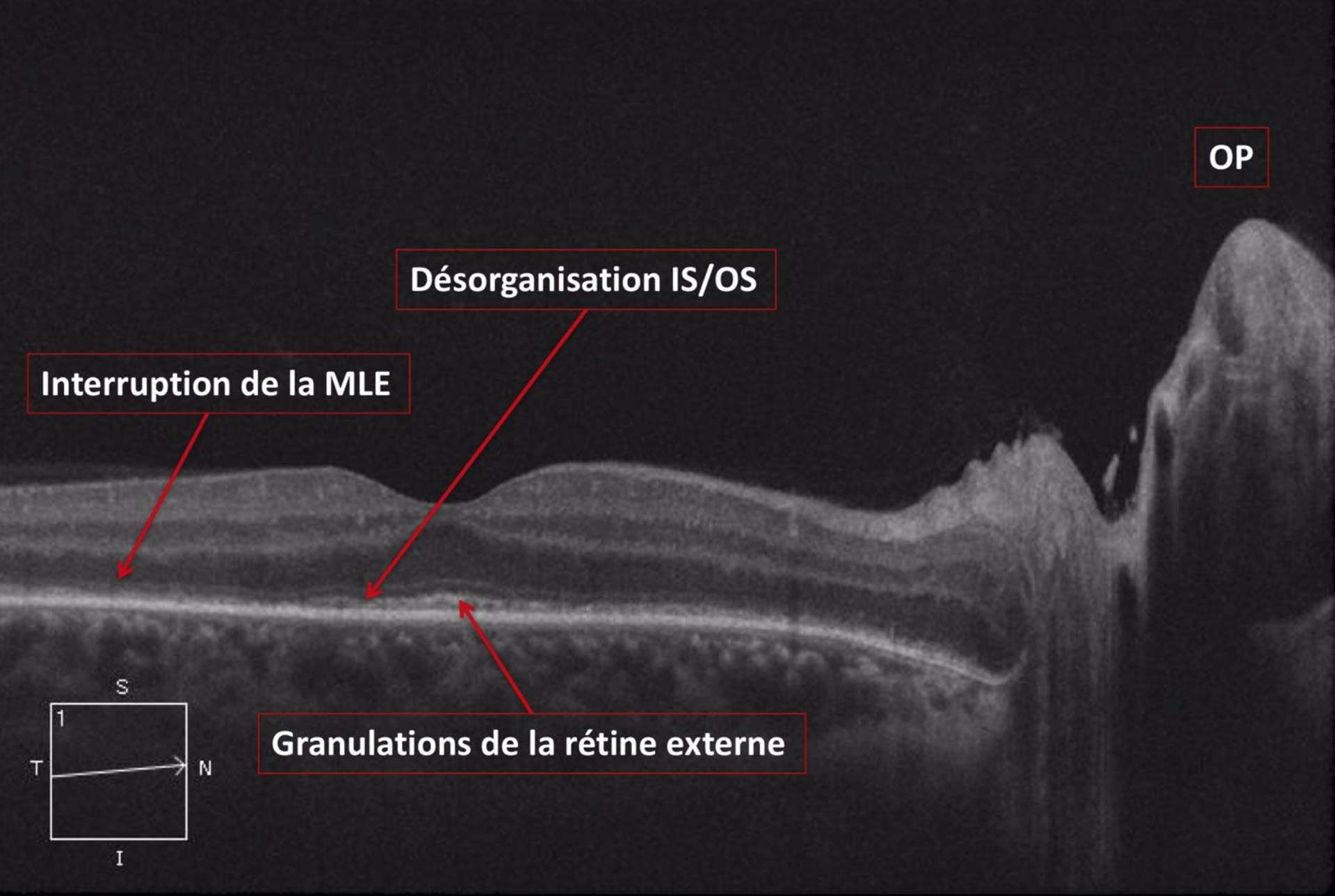 Figure 2. Coupe OCT de l’œil droit au diagnostic.
